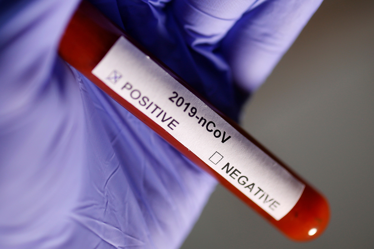 Photo shows a gloved hand holding a test tube labeled, “2019 nCoV” with two boxes ,marked “Positive” and “Negative.” The positive box is checked.