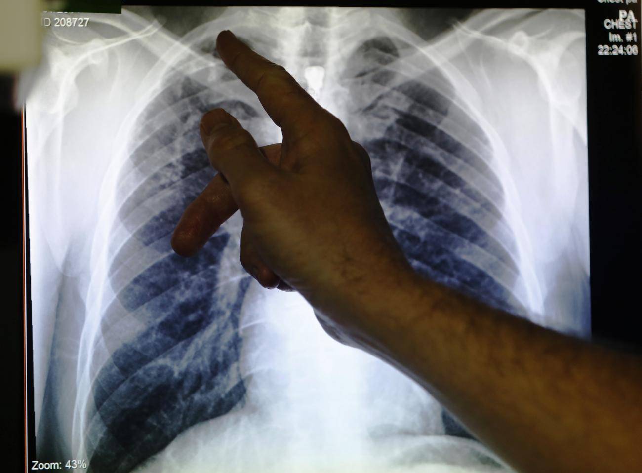 A doctor points to an x-ray showing a pair of lungs with TB (tuberculosis) in London on January 27, 2014.