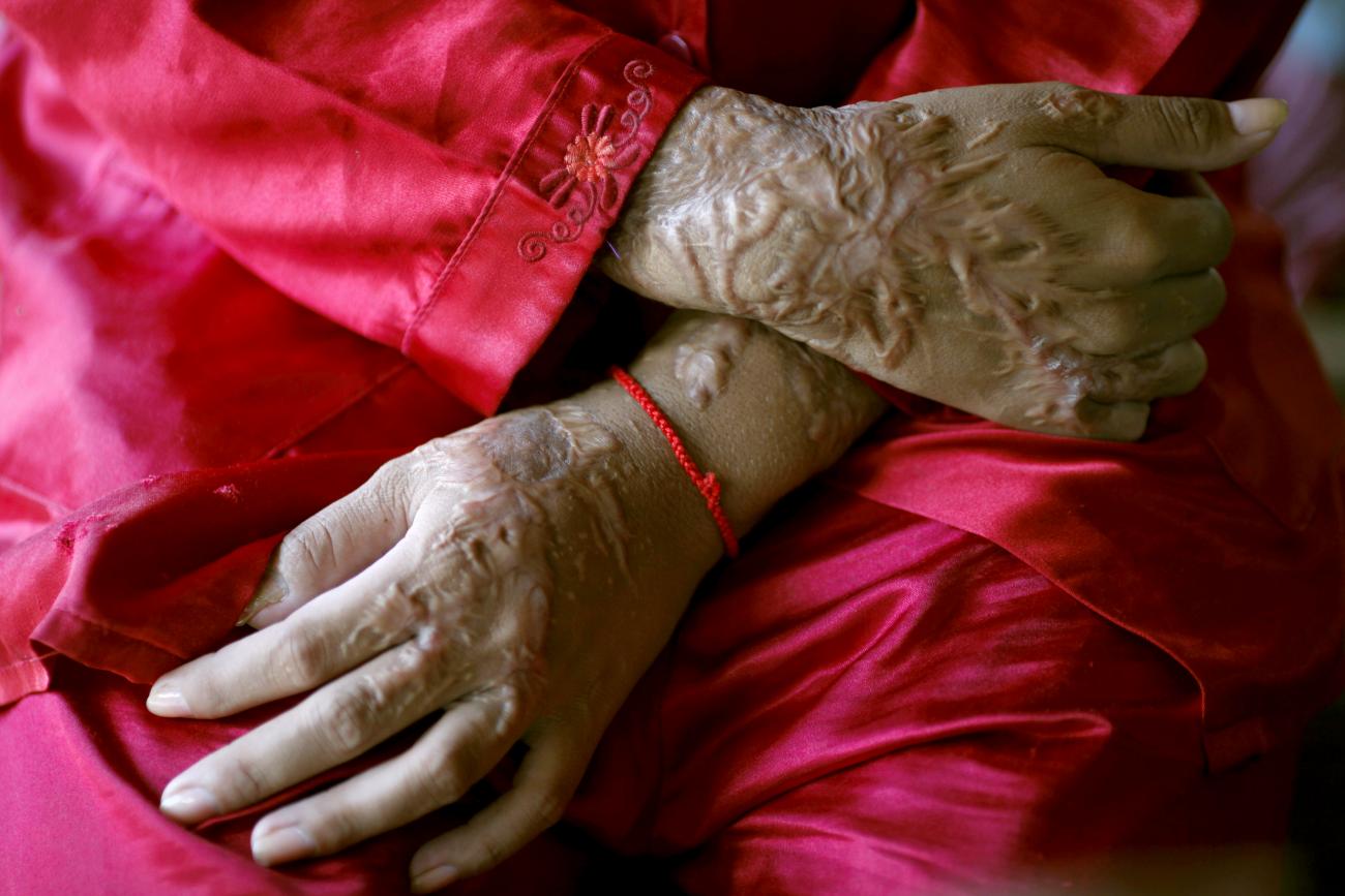 A former garment factory worker, who is an acid attack victim, sits at a secure shelter run by non-profit organization "Cambodia Acid Survivors Charity" outside Phnom Penh, Cambodia, on July 7, 2010.