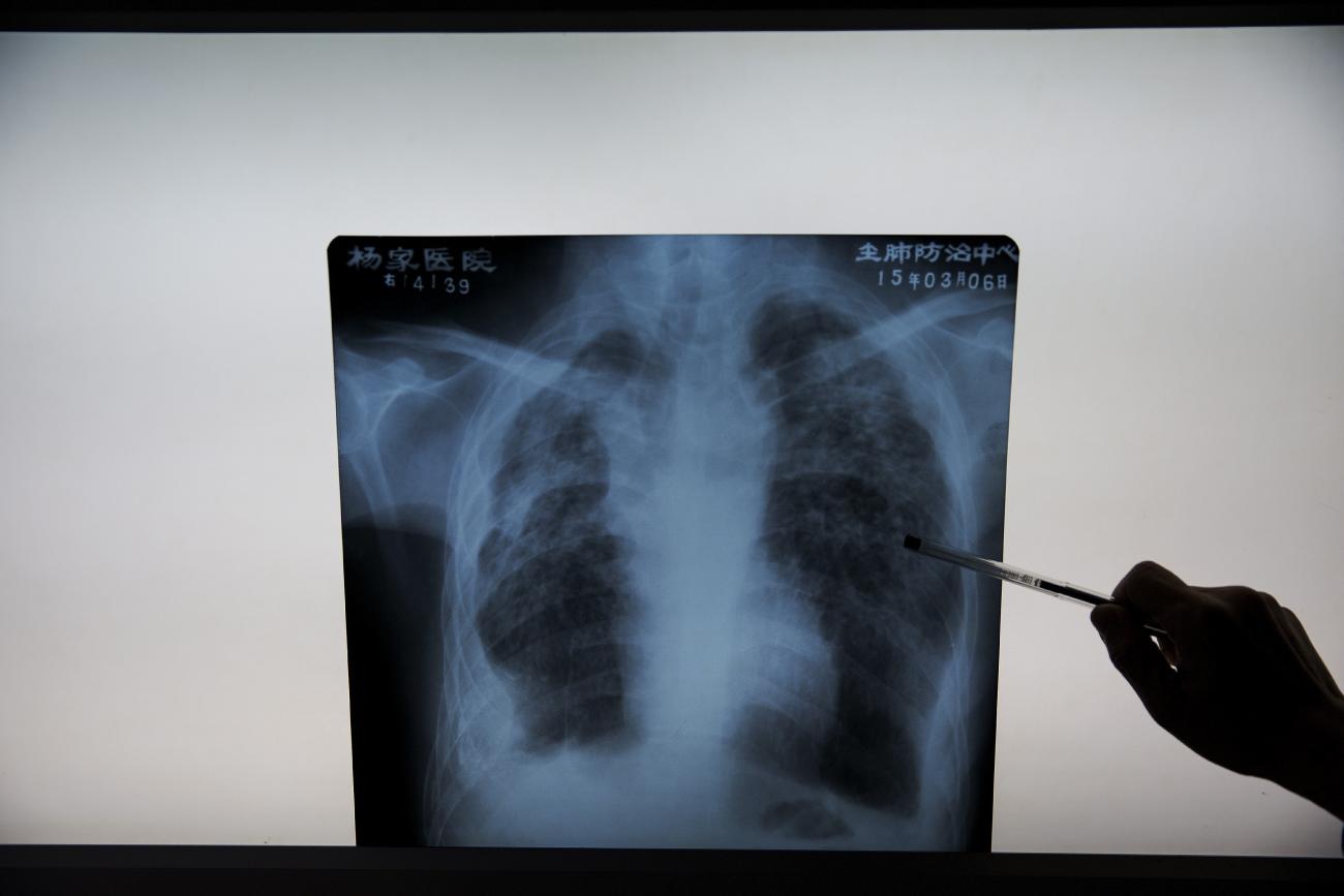 An x-ray image of the lungs of a person with pneumoconiosis, a disease caused by the inhalation of dust in the workplace.