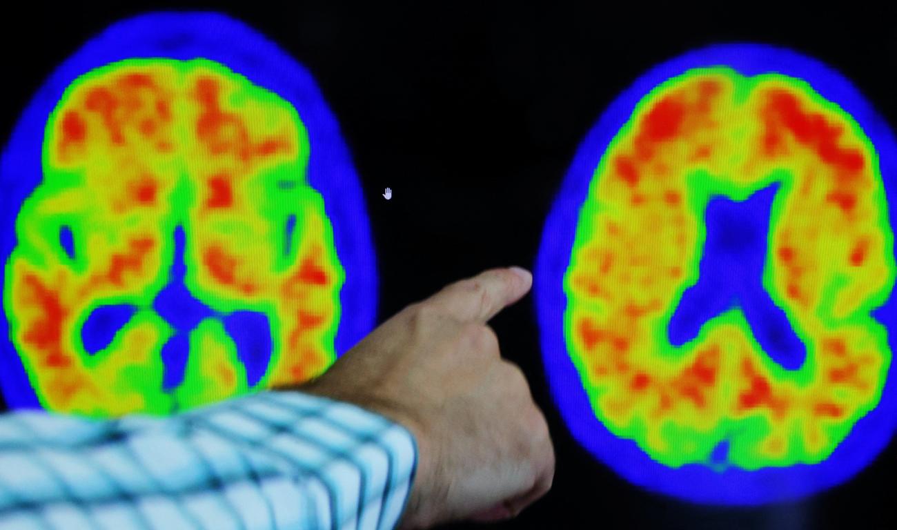 Dr. Seth Gale points out evidence of Alzheimer’s disease on PET scans at the Center for Alzheimer Research and Treatment (CART) at Brigham and Women’s Hospital in Boston, Massachusetts, on March 30, 2023.
