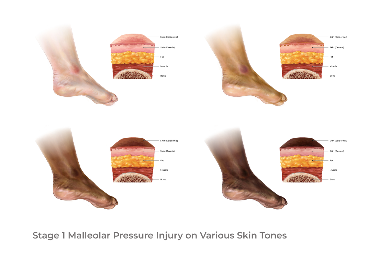 The following are four illustrations from my project, WoundWatch, depicting a stage 1 malleolar pressure injury across diverse skin tones.