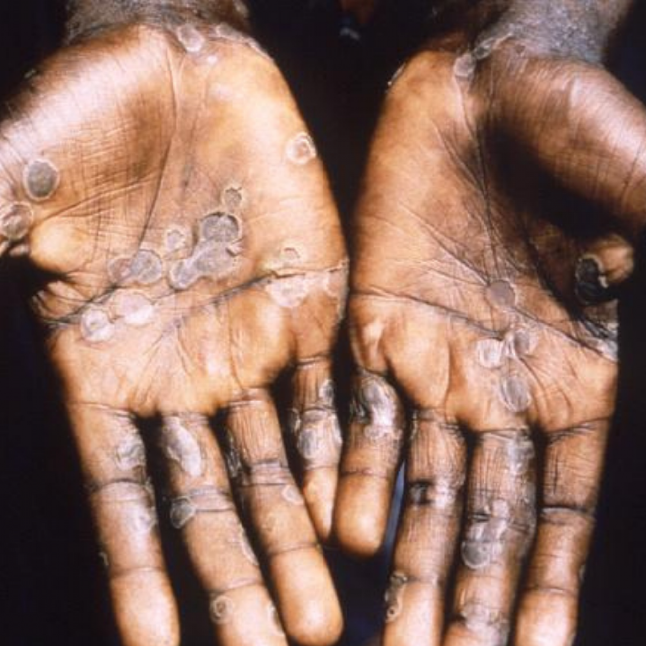The palms of a person suffering from monkeypox show small circular shaped welts. The rash is strikingly similar to a smallpox rash.