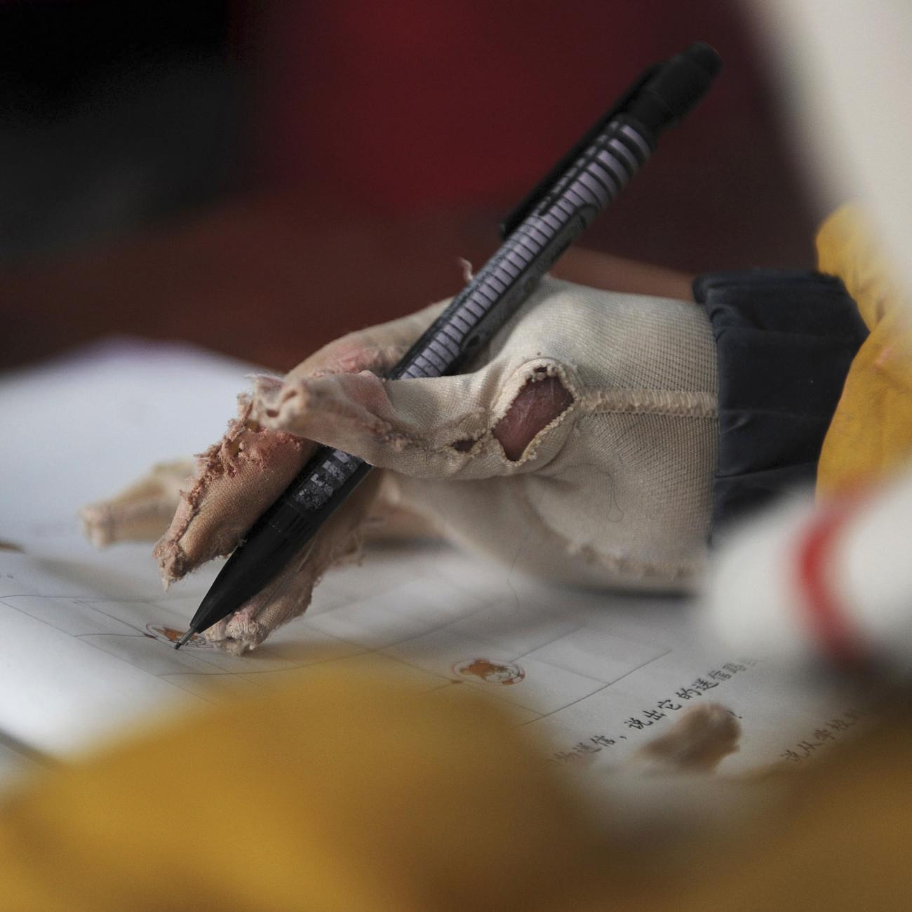 A boy, suffering from an extensive burn injury, holds a pencil to write during a lesson inside his the classroom at a primary school in Zhuanji town, Anhui province, China, on November 15, 2011.