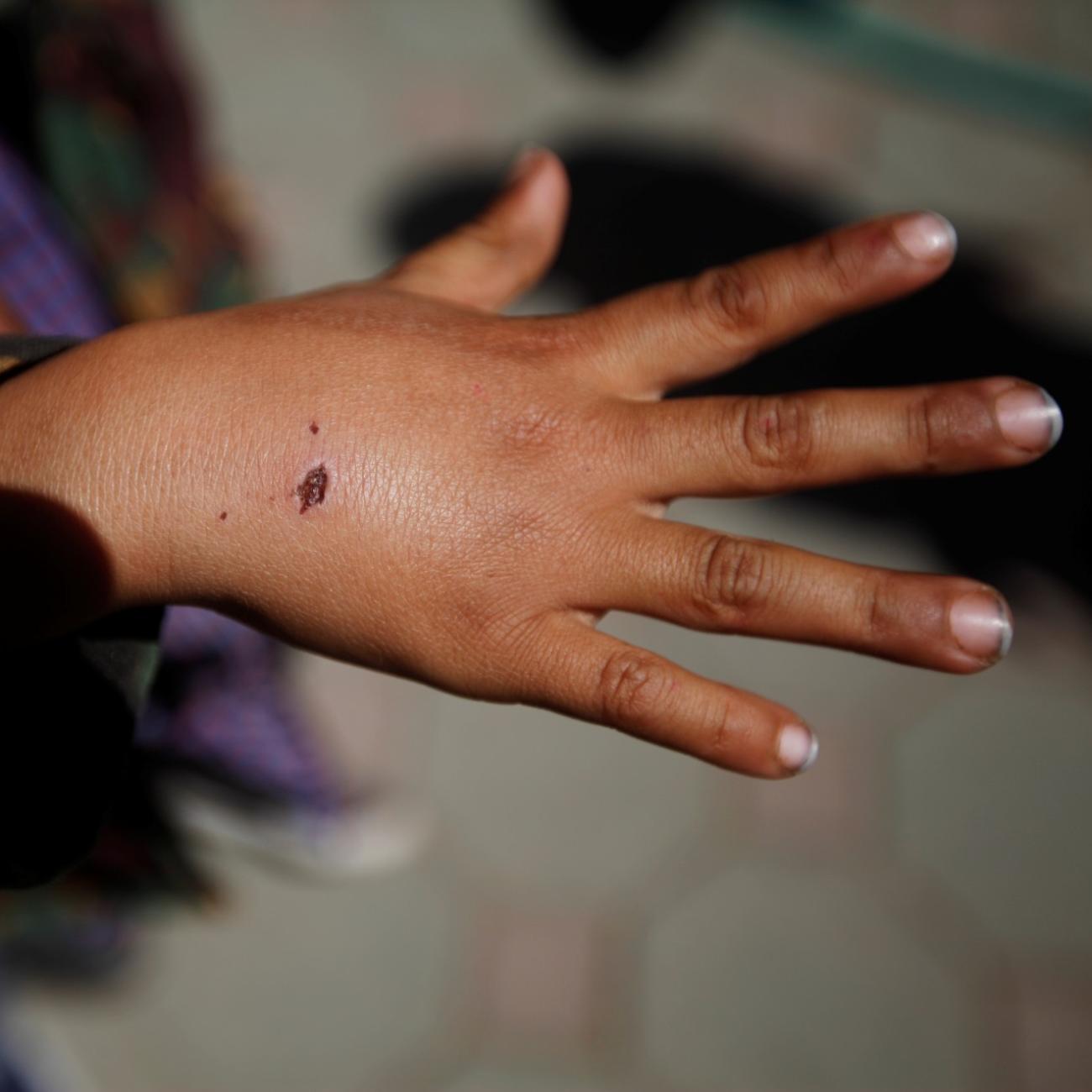 A boy shows a wound he sustained after a stray dog attacked him, at a rabies clinic in Sanaa, Yemen, on March 2, 2019. 