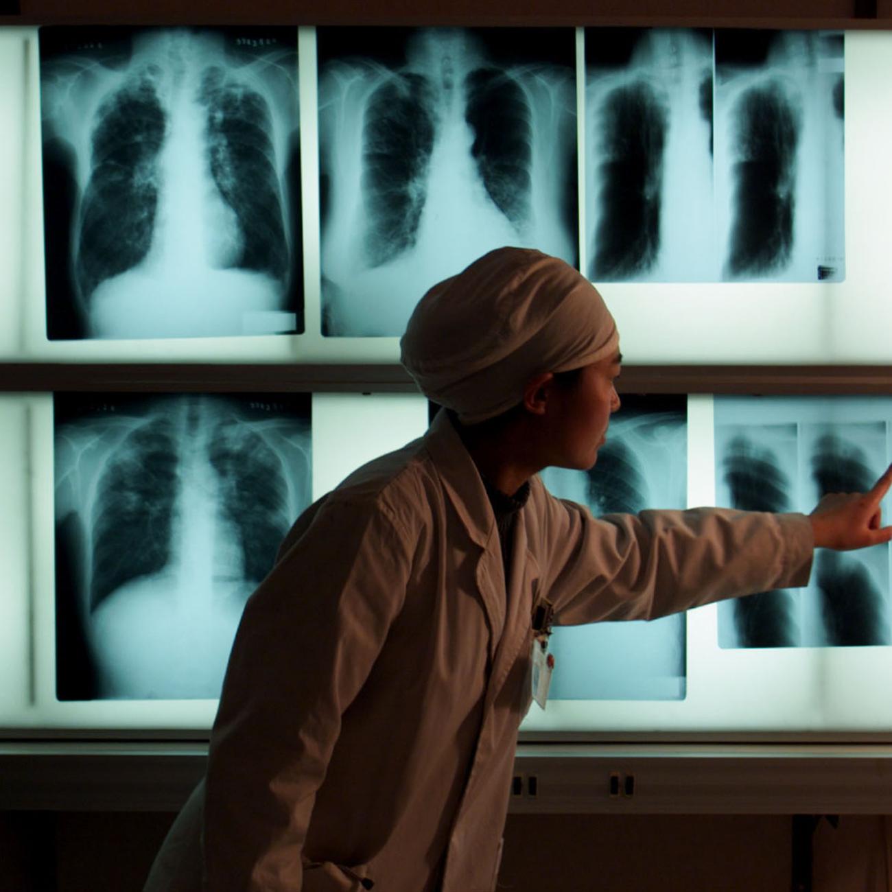 A Chinese doctor examines an x-ray of a tuberculosis patient at the Beijing Tuberculosis Hospital on March 18, 1999.