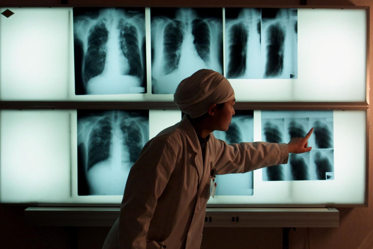 A Chinese doctor examines an x-ray of a tuberculosis patient at the Beijing Tuberculosis Hospital on March 18, 1999.