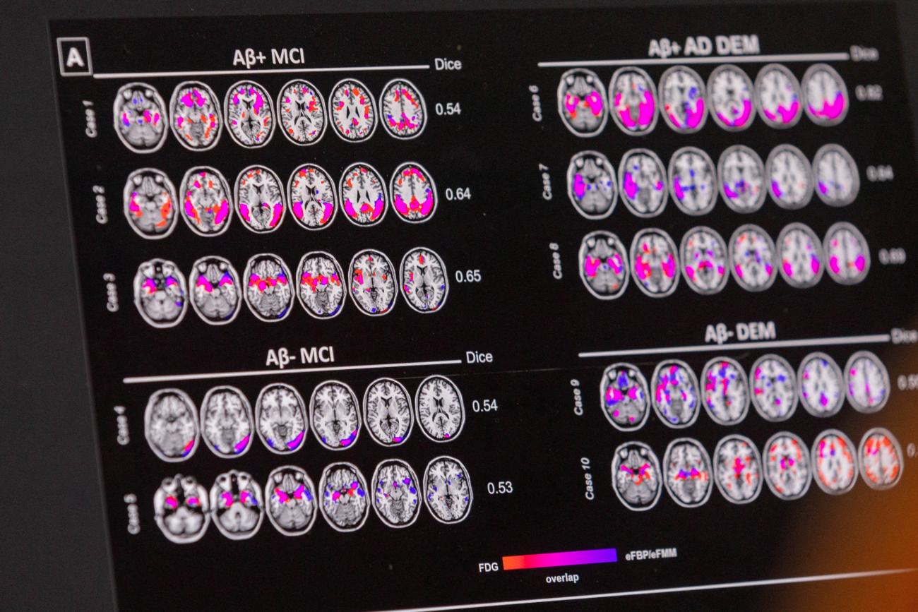 A scientist looks at hypometabolic and hypoperfusion patterns at the single-subject level from a patient with Alzheimer's disease at the Memory Centre, in Geneva, Switzerland, on June 6, 2023. 
