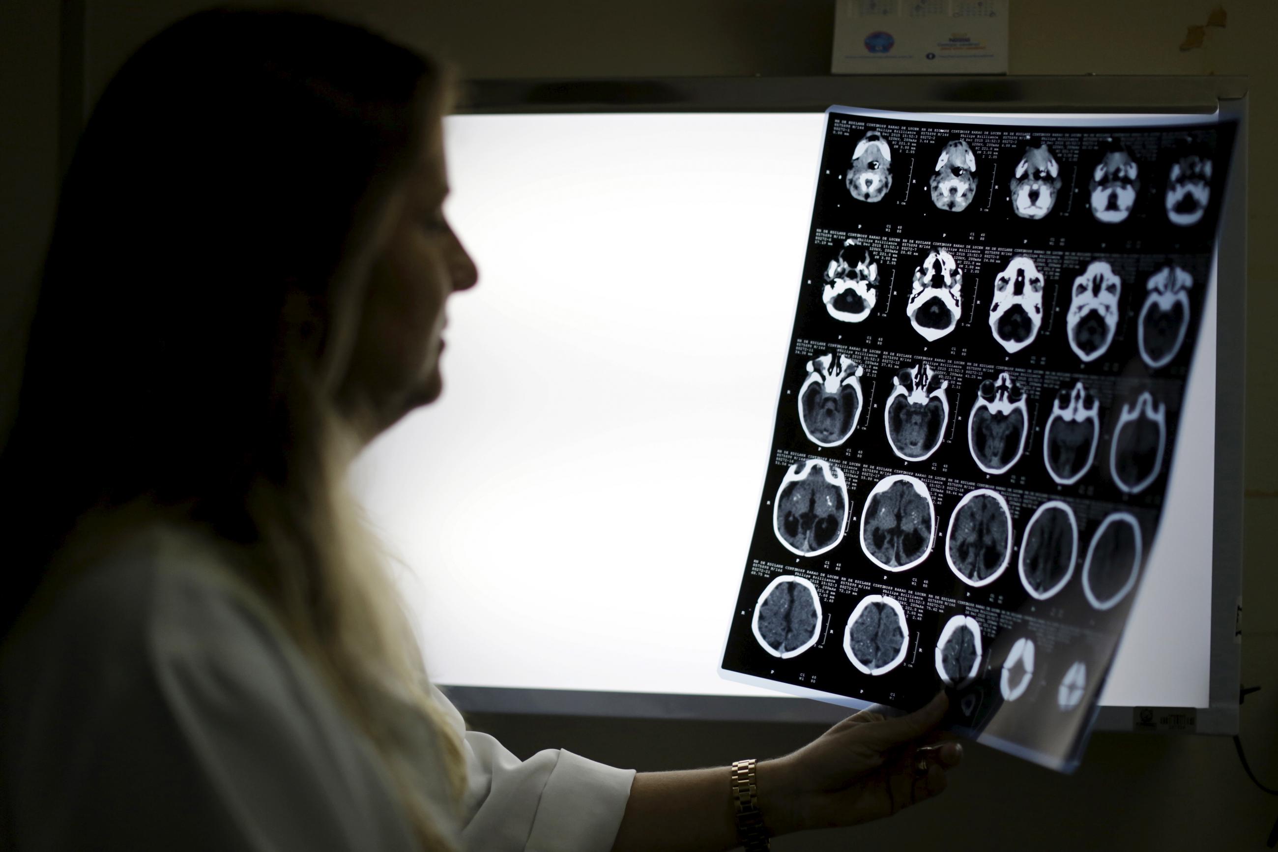 A children's neurologist observes the x-ray of a baby's skull with microcephaly at the hospital Barao de Lucena in Recife, Brazil on January 26, 2016.