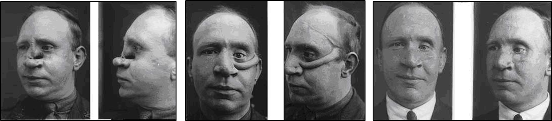 A patient of Harold Gillies showing a post-trauma defect (left)