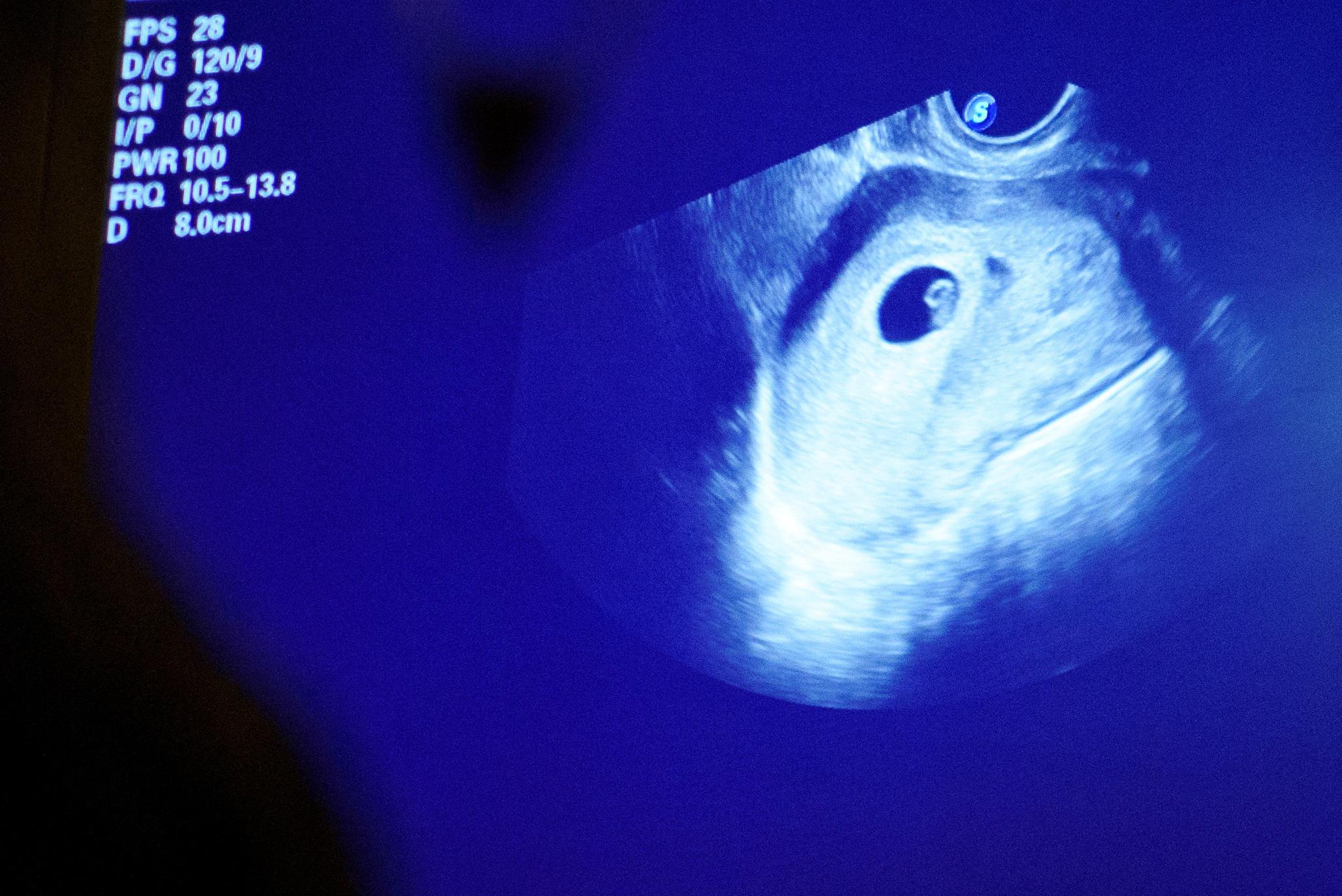 An ultrasound of a fetus. 