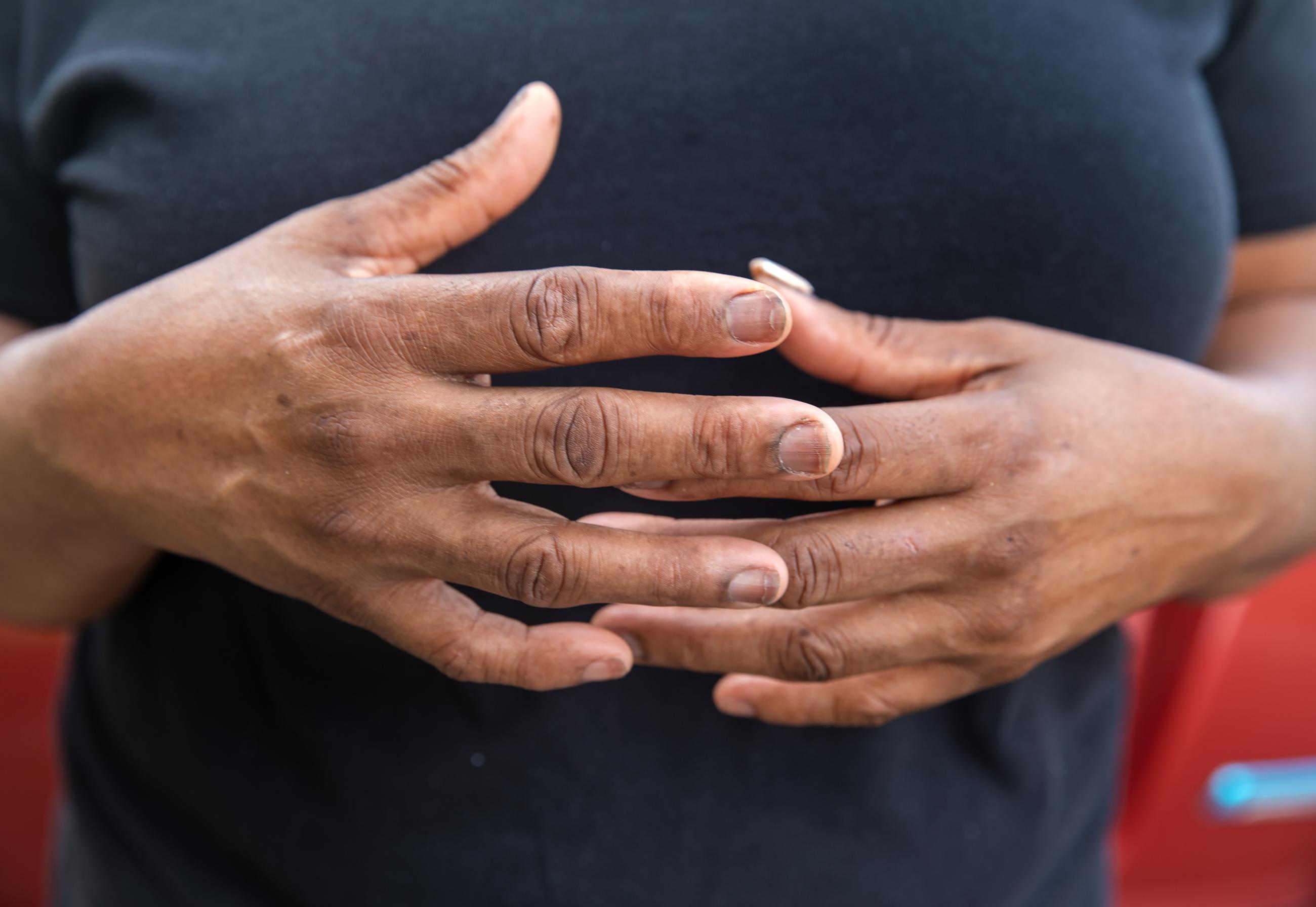 The hands of Veronica Jones, a survivor of aggressive breast cancer, are pictured, in Convent, Louisiana, on June 26, 2025. 