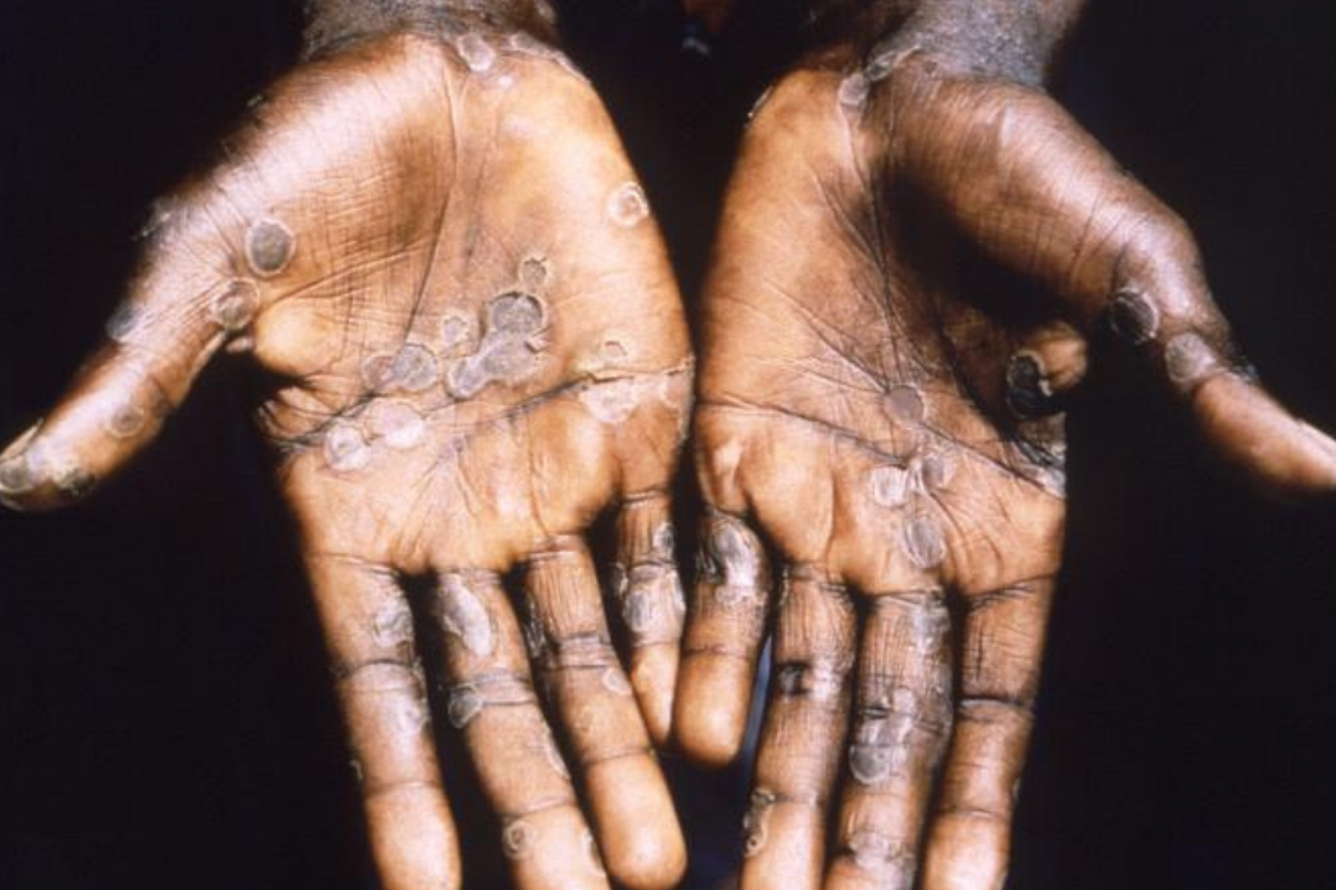 The palms of a person suffering from monkeypox show small circular shaped welts. The rash is strikingly similar to a smallpox rash.