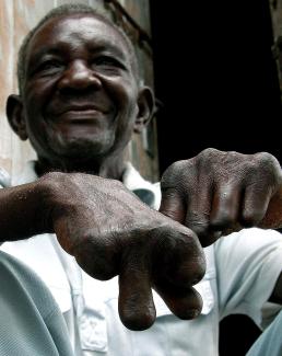 Rasmo Kirapa sits outside his room at the Nunge Centre, where people are treated for leprosy, in Dar es Salaam, Tanzania, on December 16, 2004. 