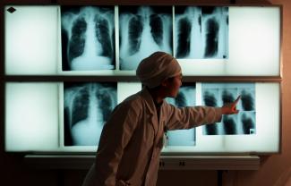 A doctor examines an x-ray of a tuberculosis patient at the Beijing Tuberculosis Hospital, on March 18, 1999.