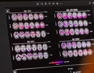 A scientist looks at hypometabolic and hypoperfusion patterns at the single-subject level from a patient with Alzheimer's disease at the Memory Centre, in Geneva, Switzerland, on June 6, 2023. 